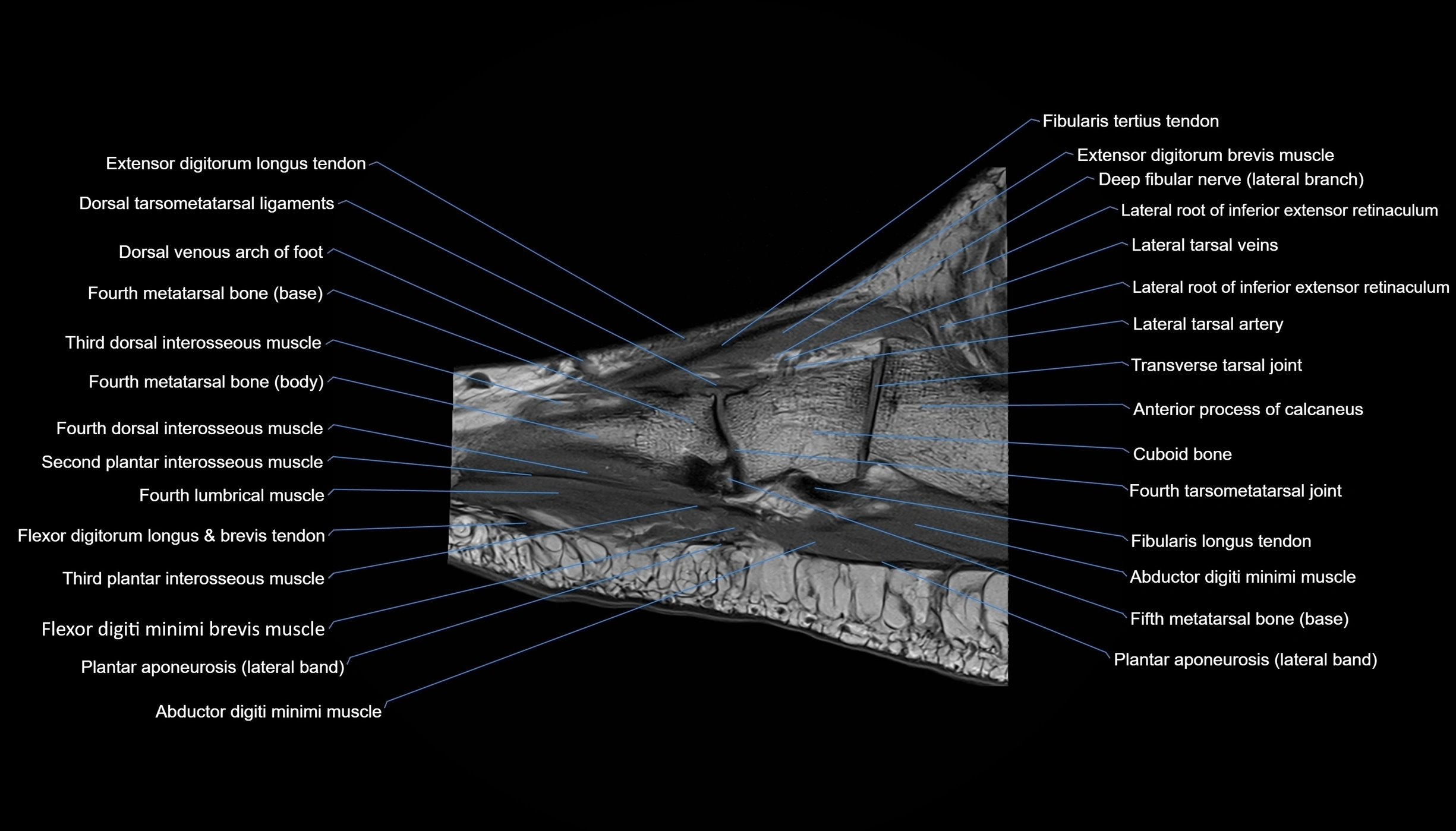MRI mid foot sagittal cross sectional anatomy 3T  radiology  image-img-00001-00012.webp